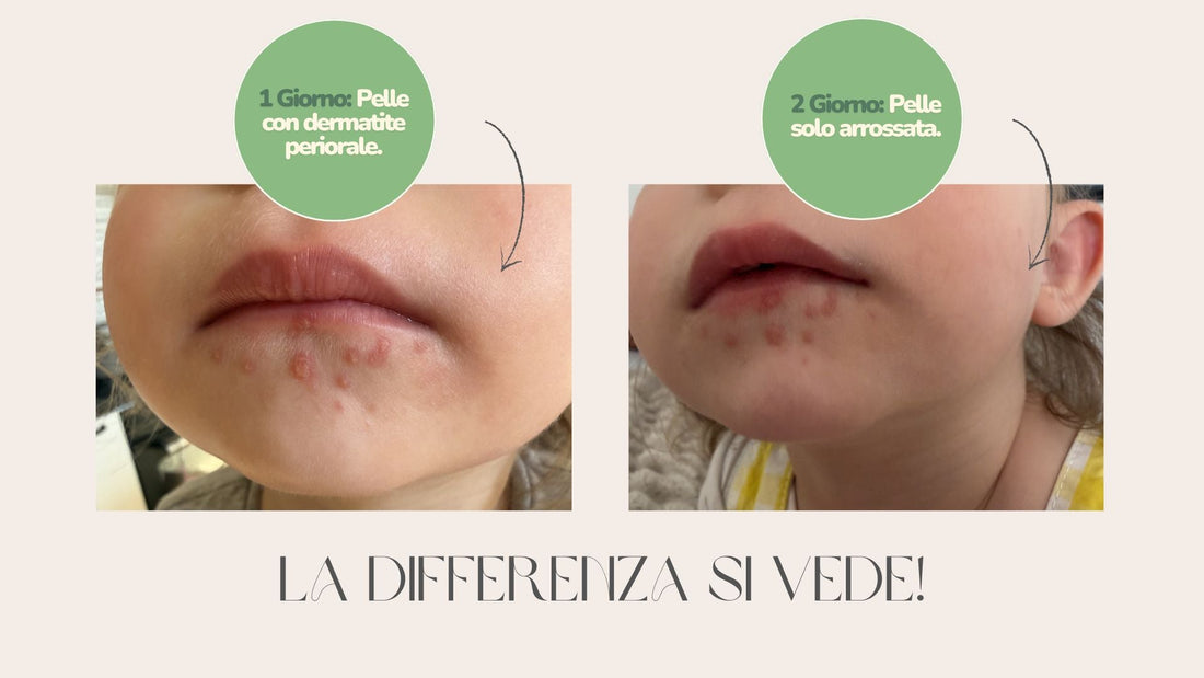 Come prevenire la pelle secca nei neonati: cause, soluzioni e prodotti consigliati