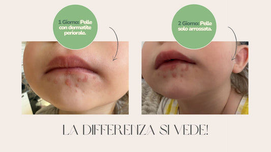 Come prevenire la pelle secca nei neonati: cause, soluzioni e prodotti consigliati